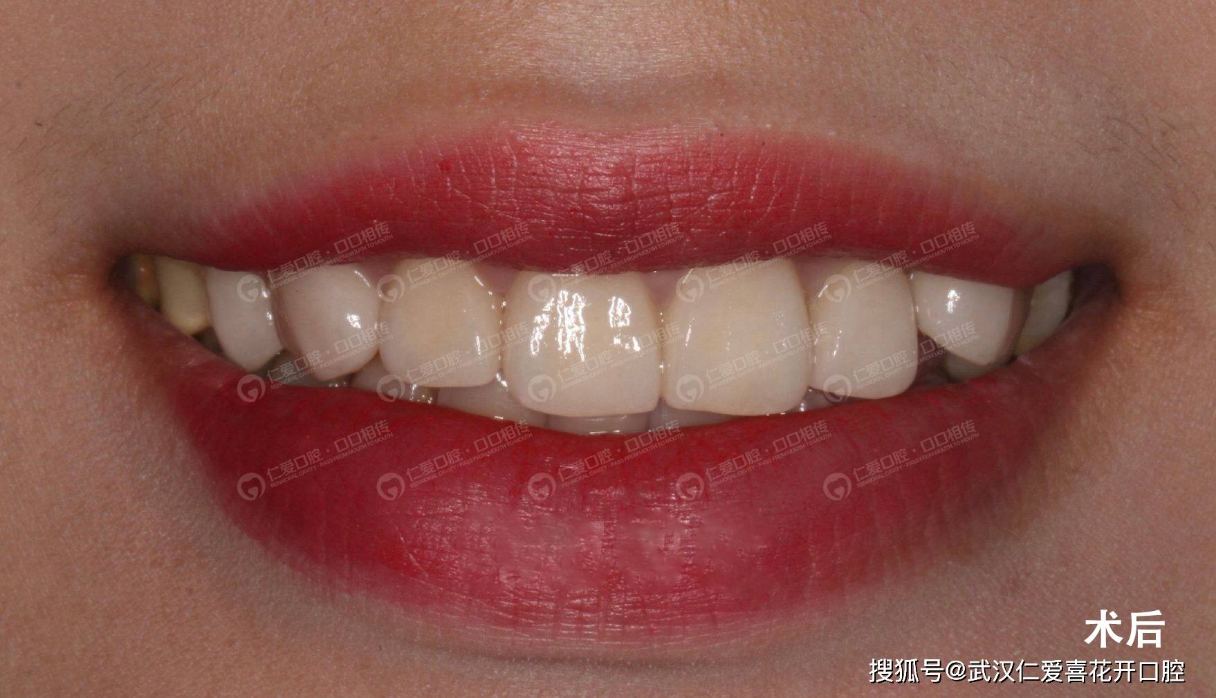 如何正确刷牙？让你的牙齿焕然一新！